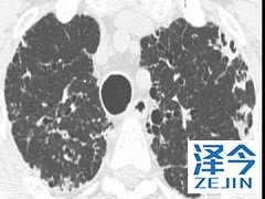 患者使用尼达尼布会产生较强的副作用吗