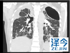 特发性肺纤维化的患者使用尼达尼布有收益吗