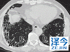 勃林格殷格翰的尼达尼布能够为IPF患者提供帮助