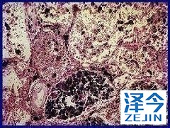 尼达尼布能够缓解患者的疾病进程